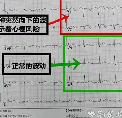 如何看心电图报告单（如何看心电图报告单体检）