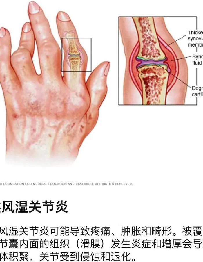 类风湿病是怎么形成的（类风湿是怎么得成的）